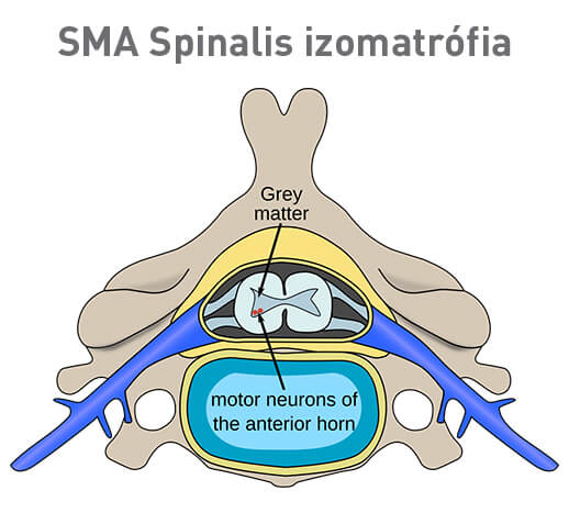 SMA Spinalis izomatrófia